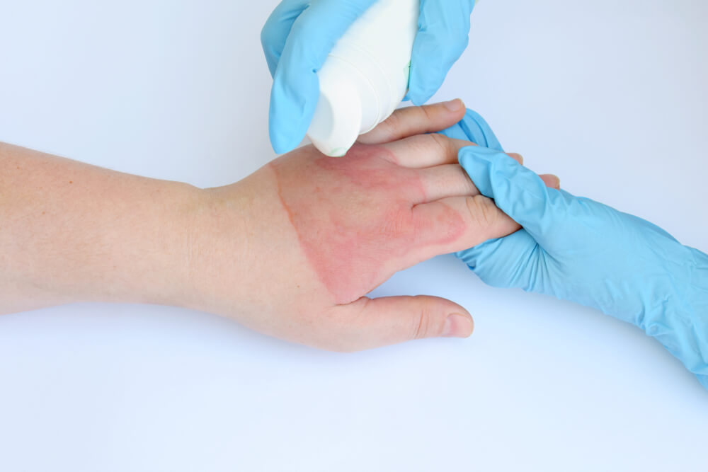 Paediatric First Aid for Burns