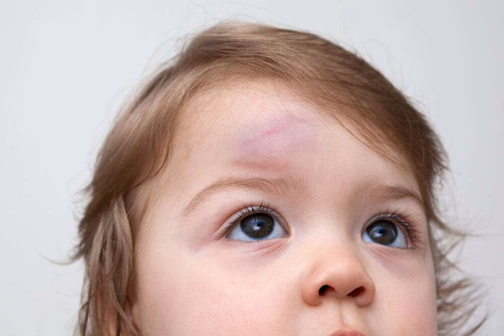 Paediatric First Aid for Head Injuries